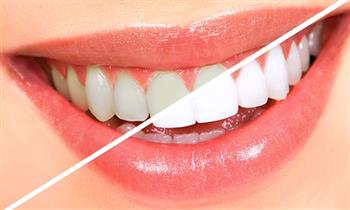 4 sesiones de blanqueamiento LED 2 curaciones simples fluorizacion y mas