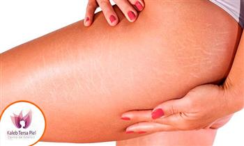 10 sesiones de tratamiento atenuador de estrias con carboxiterapia