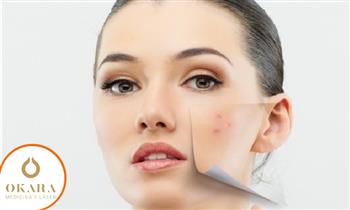 ¡Para ellos y ellas! Tratamiento dermatologico con laser IPL para acne o rosacea en Okara