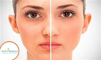 3 sesiones de fotorejuvenecimiento facial con laser IPL
