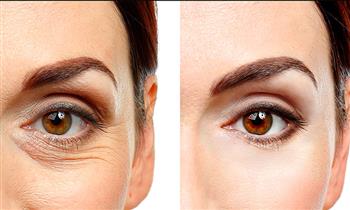 Cirujia de Blefaroplastia o y m´s