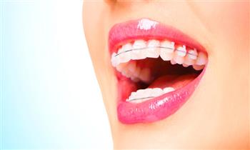 brackets metalicos o transparentes destartaje profilaxis y mas