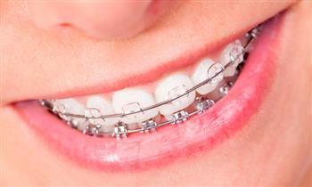 Brackets o mini brackets transparentes o metalicos instalacion modelo de estudio y mas