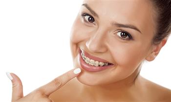 Brackets metalicos odontograma fluorizacion y mas