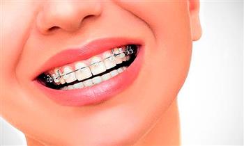 Brackets metalicos mini brackets o brackets transparentes Blanqueamiento y mas