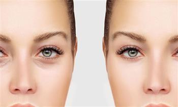 Tratamiento de eliminacion de ojeras carboxiterapia Drenaje linfatico y mas