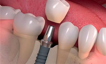 Implante dental de titanio en Esthetic dental center