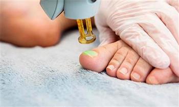 04 sesiones de laser HIL para tratamiento de hongos en uñas consulta