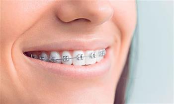 instalacion de brackets mini profilaxis fotos videos y modelos y mas