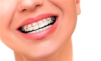 Brackets metalicos o transparentes destartraje y mas