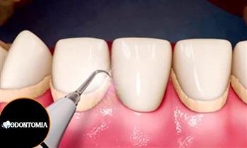 Sesion de limpieza dental total destartraje profilaxis