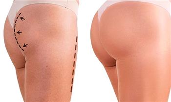 aplicacion de peptona para aumento de gluteos ¡Elimina la celulitis y modela la cadera!
