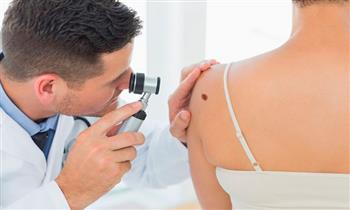 Remocion de 2 4 5 ml de lunares o verrugas con Laser CO2
