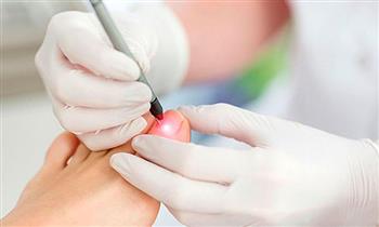 4 sesiones de tratamiento laser para hongos para los 2 pies y mas