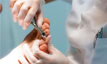 Profilaxis clinico en pie corte de uña clinico retiros de helomas y mas