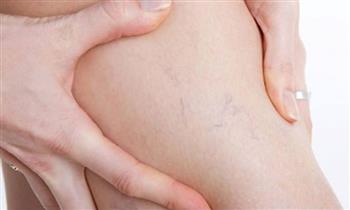 San Borja 2 o 4 sesiones de tratamiento Spider laser y mas