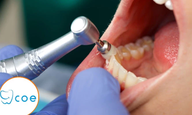 Paquete de  Limpieza dental profunda con destartaje + profilaxis y más