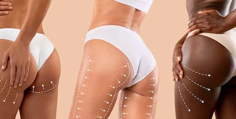 Sesiones de moldeado de glúteos + 04 radio frecuencia y más