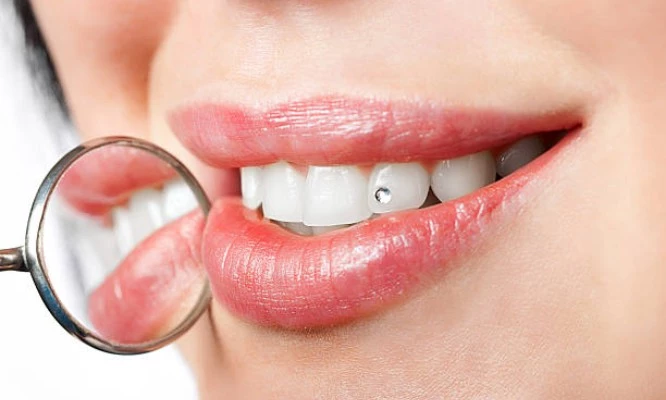 ¡PACK JOYA DENTAL! Profilaxis dental profesional + 1 joya dental+