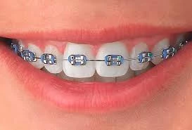 Brackets o Mini Brackets  + limpieza dental y más