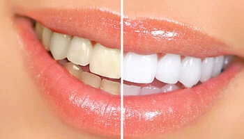 Paquete de blanqueamiento dental: profilaxis, blanqueamiento, flúor y más en MOLAR 360