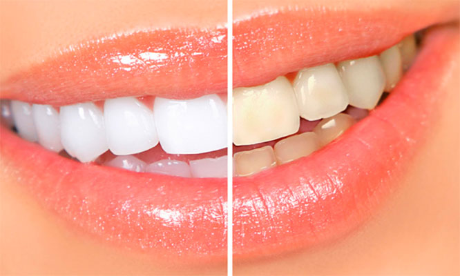 2 Sesiones de Blanqueamiento Desinfeccion gingival Fluorizacion