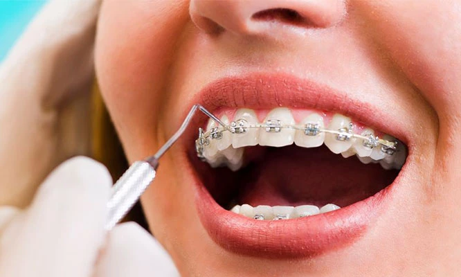 brackets metálicos  o mini brackets a elección + 2 resinas simple