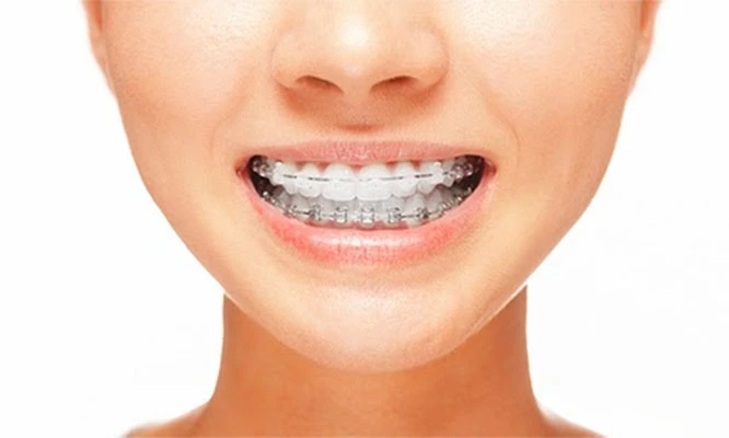 Brackets metálicos, transparentes o mini brackets + Limpieza con ultrasonido y más