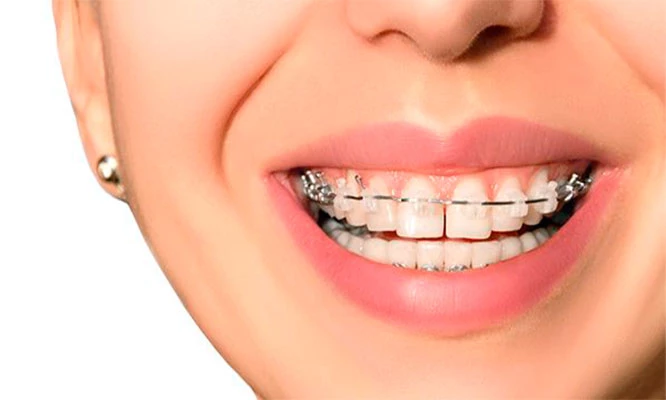 Brackets Transparentes o Metálicos y más. Recupera tu sonrisa ¡Ya!