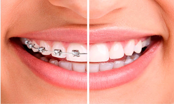 Brackets Transparentes o Metálicos y más. Recupera tu sonrisa ¡Ya!