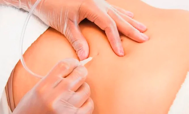 Tratamiento reductor + tonificación cuerpo completo 12 visitas, carboxiterapia , drenaje linfático y más