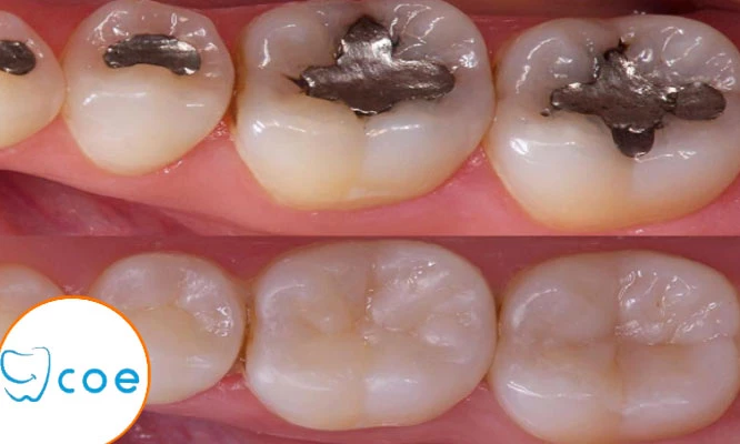 Cambio de amalgama por resinas + fluorización + odontograma y más