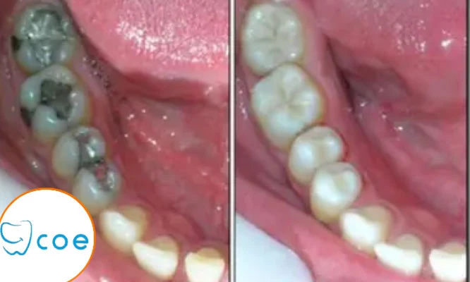 Cambio de amalgama por resinas + fluorización + odontograma y más