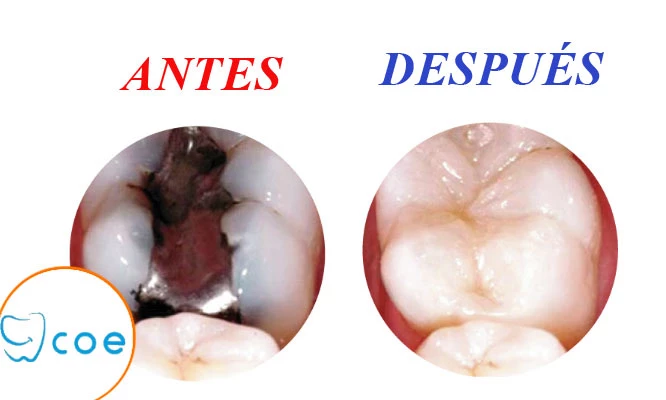 Cambio de amalgama por resinas + fluorización + odontograma y más