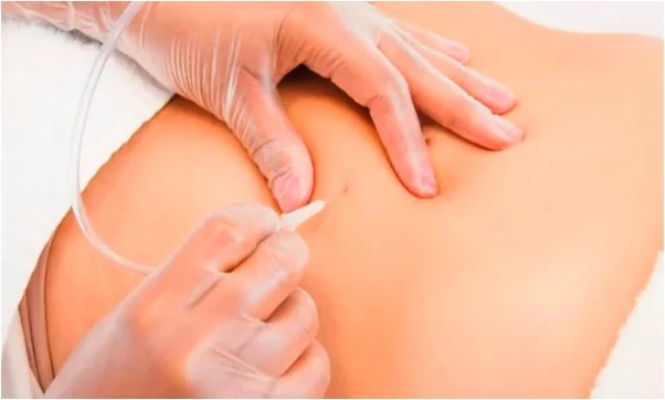 tratamiento reductor en 12 visitas, carboxiterapia, drenaje linfático, ultra cavitación y más en  Beauty & Health