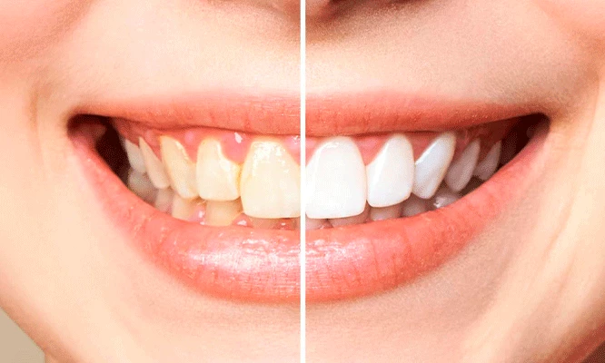 2 Sesiones de Blanqueamiento Dental LED