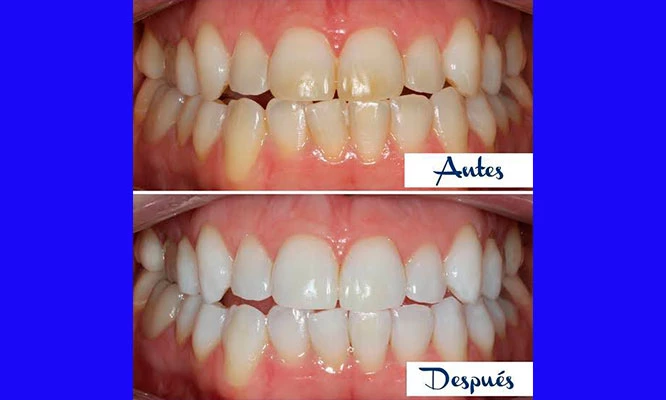 02 Sesiones de blanqueamiento dental + profilaxis