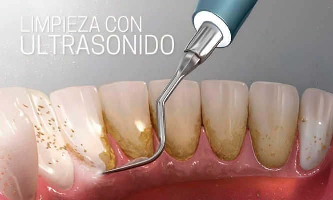 Limpieza con ultrasonido + Destartraje + Profilaxis + Flúor + Odontograma.