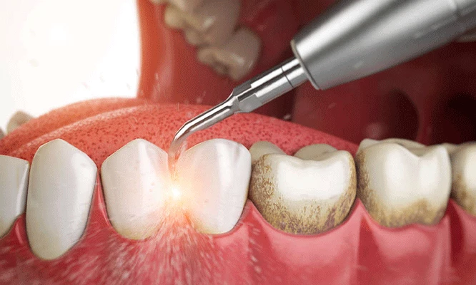 limpieza dental profunda con (ultrasonido+odontograma+alisado radicular+profilaxis+flúor) en FioDent.