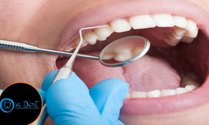 Limpieza dental: destartraje + ultrasónico + raspaje y alisado radicular y más