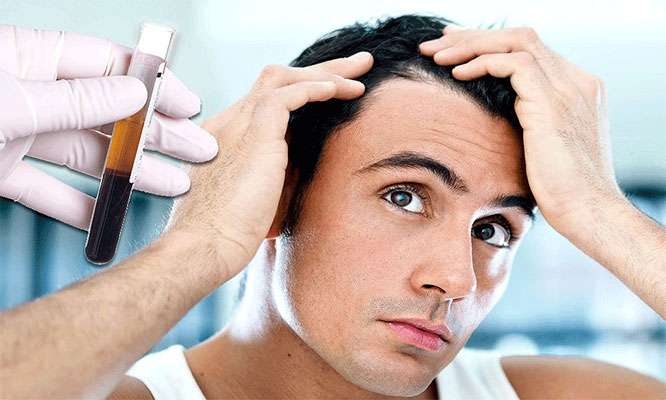 Plasma Rico en Plaquetas para alopecia 8 tubos de plasma rico en Plaquetas y mas