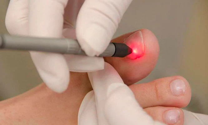 5 sesiones de tratamiento láser para hongos para los 2 pies y más.