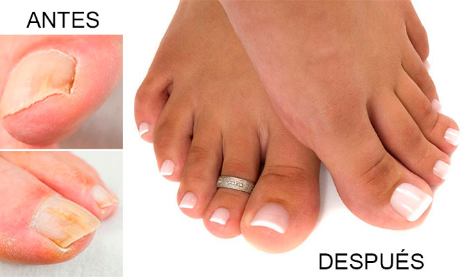 Pies con hongos antes y despues de adelgazar