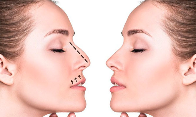 Rinoplastia en Arroyo Cirujanos