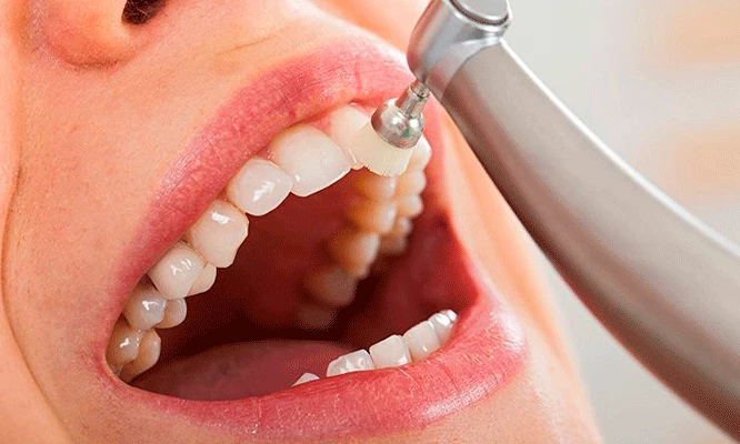 Limpieza Dental (Destartraje) con ultrasonido + profilaxis + fluorización + consulta especializada.