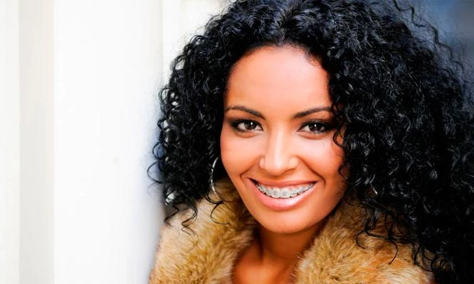 Instalación de Brackets metálicos o transparentes